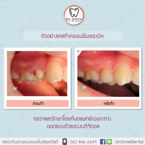 Template-รีวิวเคสครอบฟัน-01-01