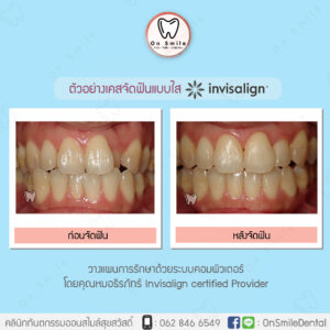 Template-รีวิวเคสจัดฟันแบบใส-01