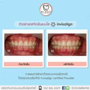 Template-รีวิวเคสจัดฟันแบบใส-02-01