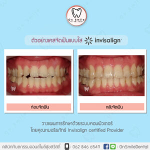 Template-รีวิวเคสจัดฟันแบบใส-03-01
