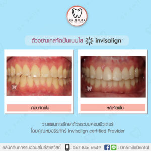 Template-รีวิวเคสจัดฟันแบบใส-04-01