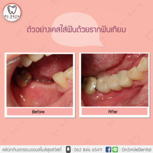 Template-รีวิวเคสรากเทียม-06-01-1